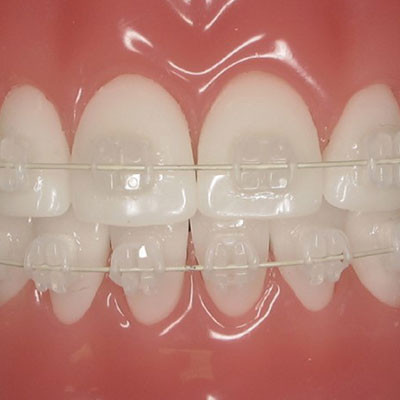 براکت سرامیکی شفاف برای زیبایی ارتودنسی