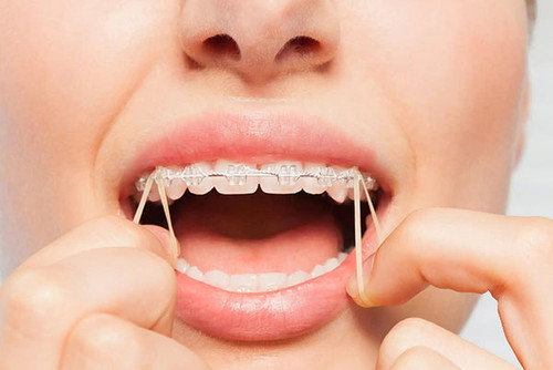 بسته کش ارتودنسی انواع سایز و رنگ