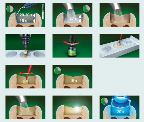 باند گلوما کولزر Gluma Bond KULZER panamal.ir